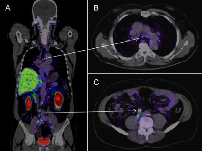 The Role of PET Scans in the Diagnosis and Treatment of Cancer -  CancerConnect