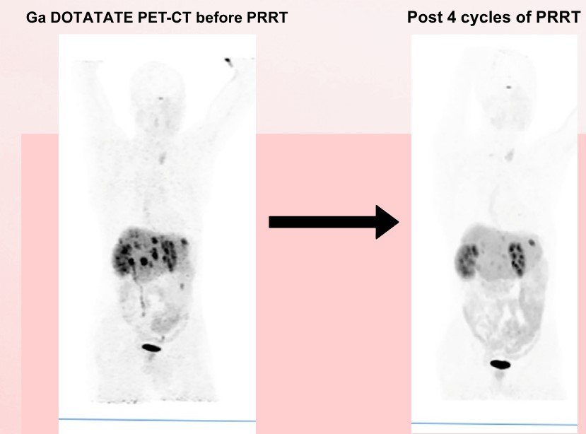 Indications Radioiodine Therapy