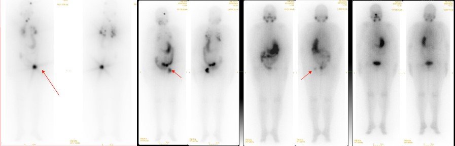 Indications Radioiodine Therapy