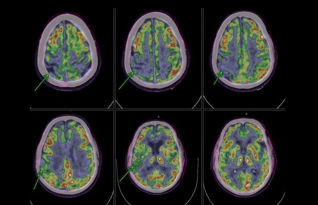Gamma Camera Scan in Rohtak